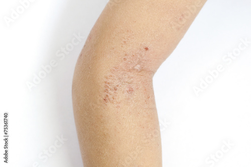 Eczema
