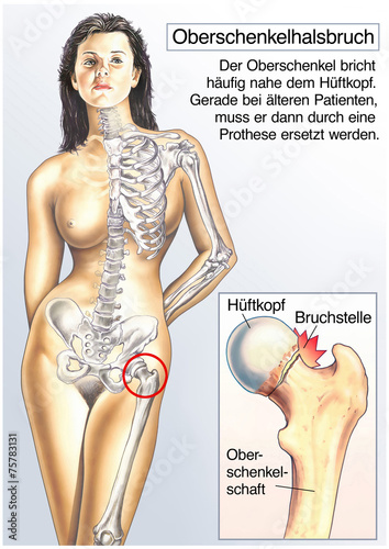 Oberschenkelhalsbruch photo