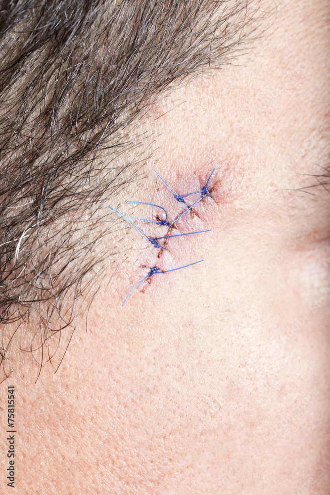 280+ Stitches On Man Face Stock Photos, Pictures & Royalty-Free Images -  iStock