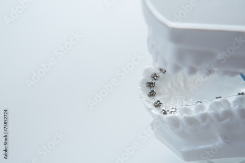 Dental lower jaw bracket braces model on white