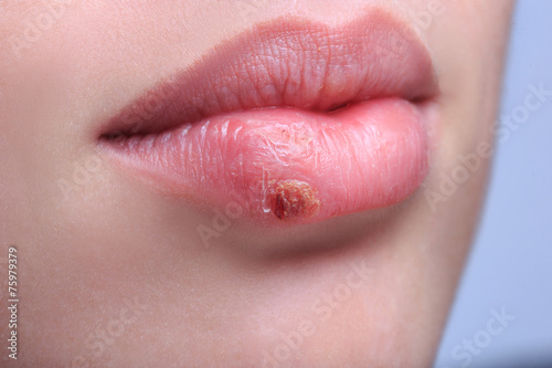beautiful lips virus infected herpes photo