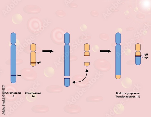 Burkitt's lymphoma translocation