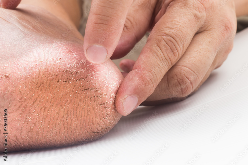 Fototapeta premium Hand embracing a badly cracked heel