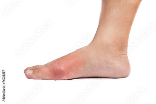 Painful gout inflammation on big toe joint