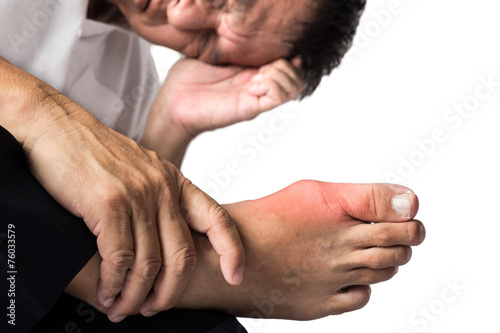 Fototapeta Man with painful and swollen right foot due to gout inflammation