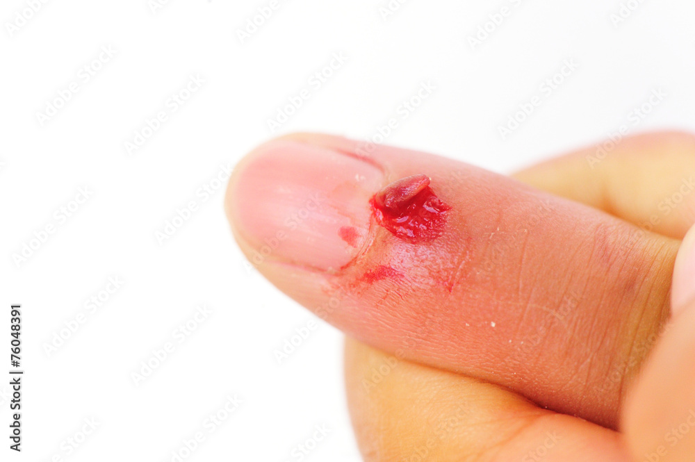 Fototapeta premium wound in finger