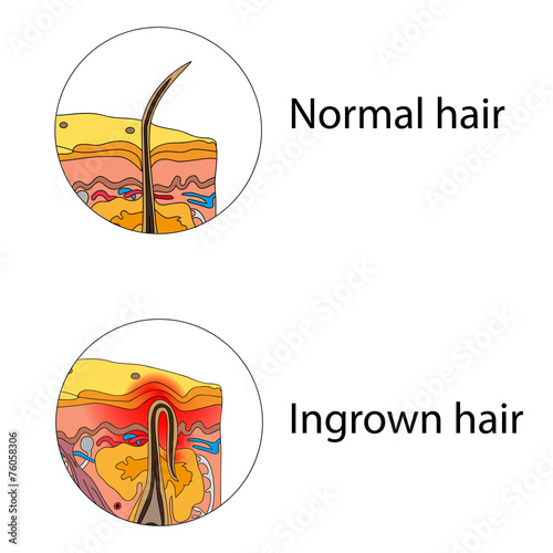Ingrown hair
