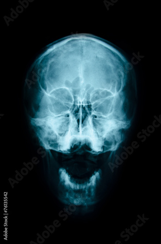 film x-ray Skull AP : show normal human's skull