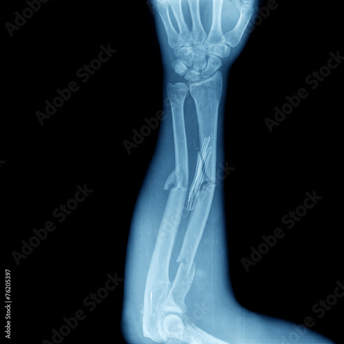 xray of broken arm