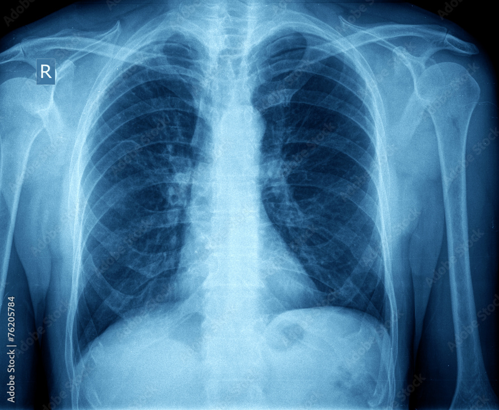 xray of chest