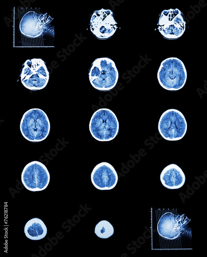 CT scan (computed tomography) of normal brain ( cerebrovascular