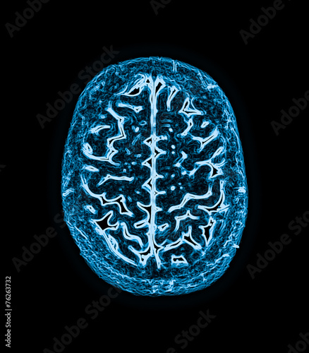 magnetic resonance image (MRI) of the brain