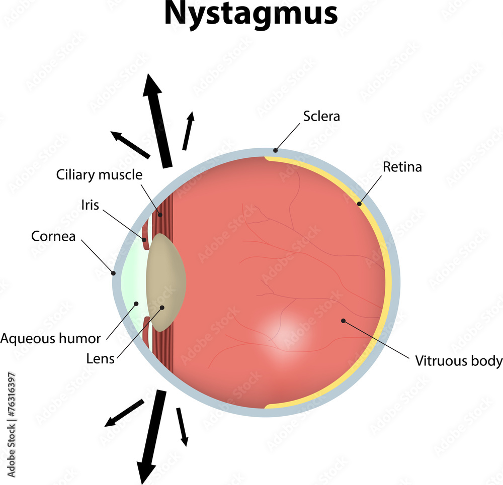 Nystagmus Labeled Diagram Stock Vector Adobe Stock