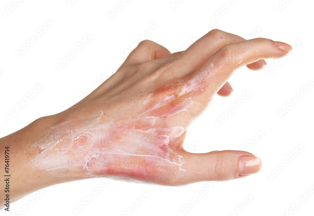 Treatment of burns on female hand isolated on white Treatment of burns on female hand isolated on white