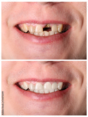 Incisive tooth restoration before and after treatment