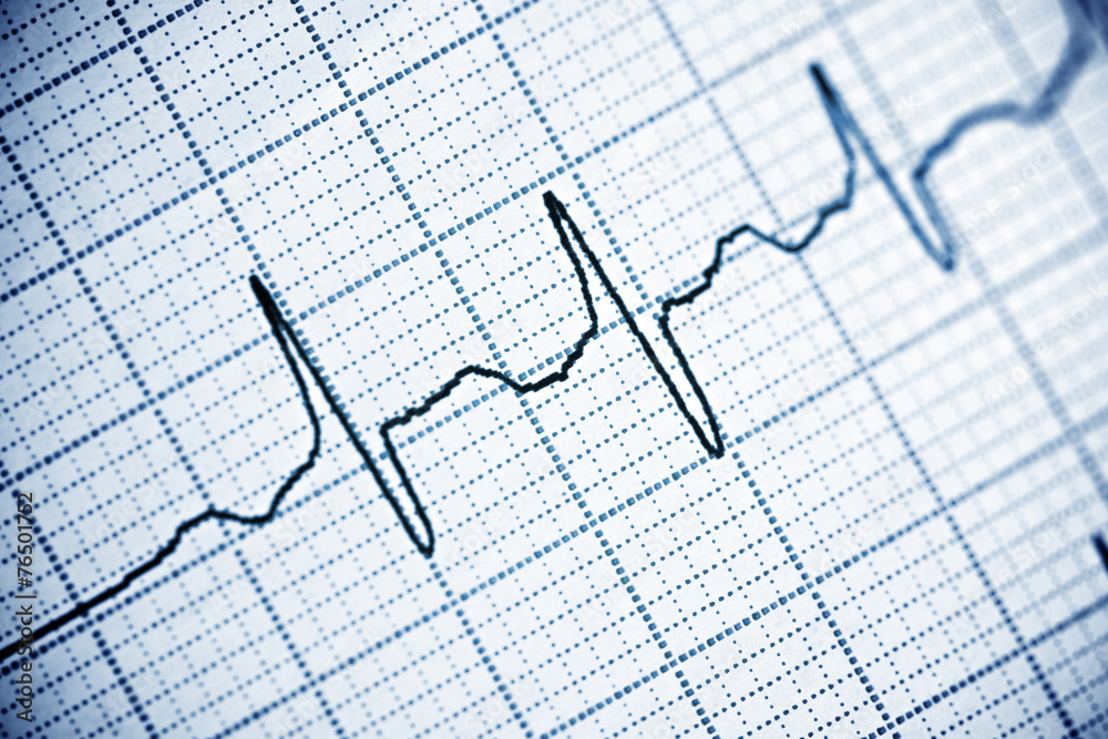 Electrocardiogram Electrocardiogram