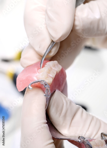 Proteza zębowa częściowa na łuku akrylowym