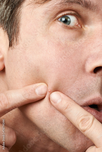Men squeezing a pimple