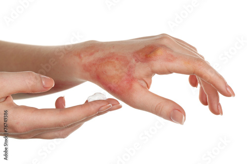 Obraz na płótnie Treatment of burns on female hand isolated on white