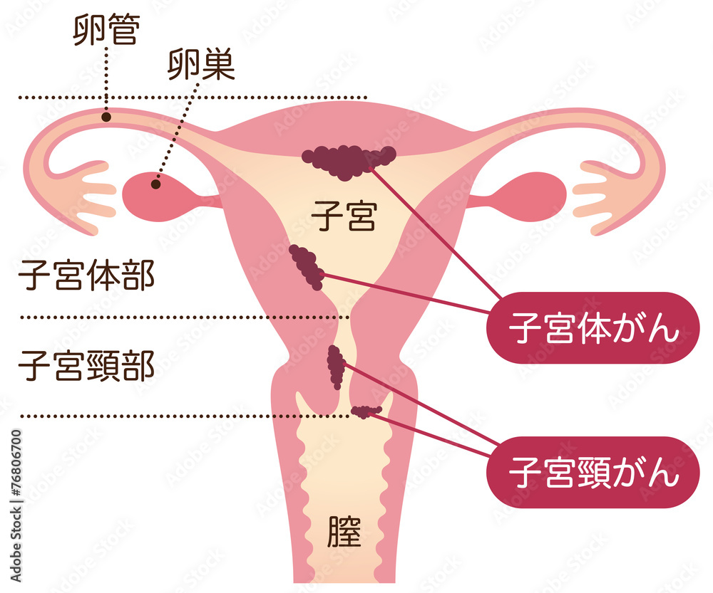 Fototapeta premium 子宮がん 女性のからだ