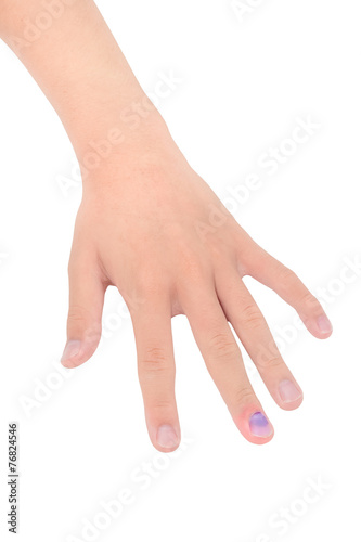 hand with Bruised Nail  Isolated on white background