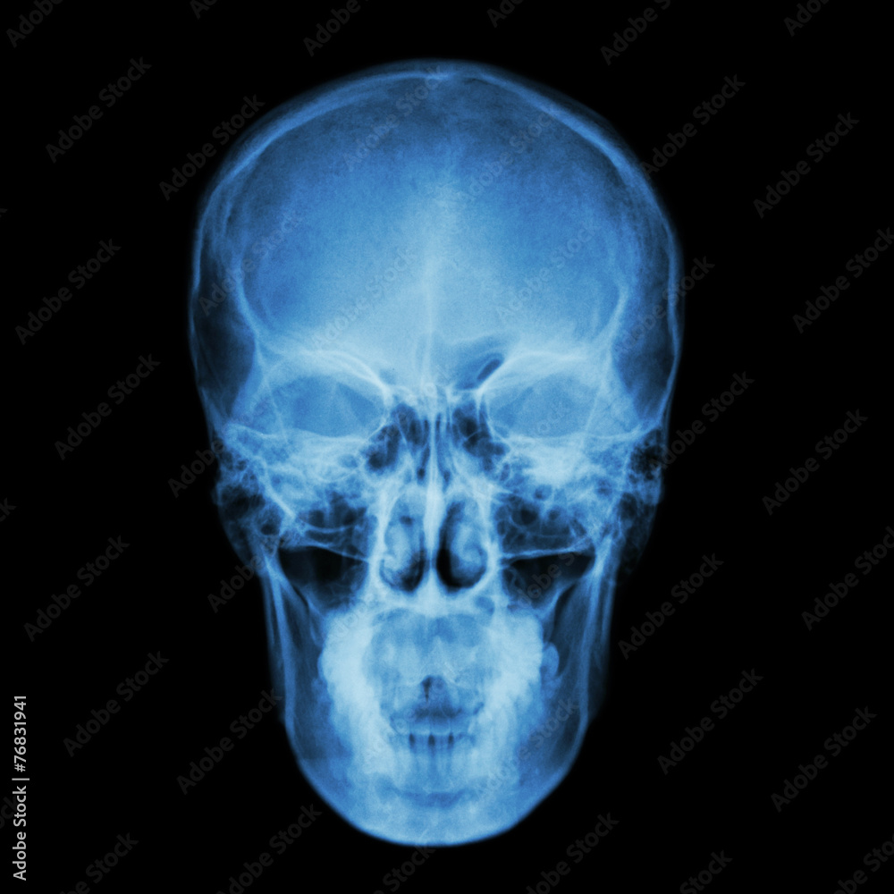 X-ray skull and Stroke ( cerebrovascular accident (CVA) ) X-ray skull and Stroke ( cerebrovascular accident (CVA) )
