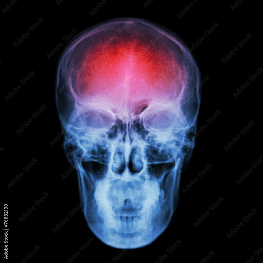 X-ray skull and Stroke ( cerebrovascular accident (CVA) ) X-ray skull and Stroke ( cerebrovascular accident (CVA) )