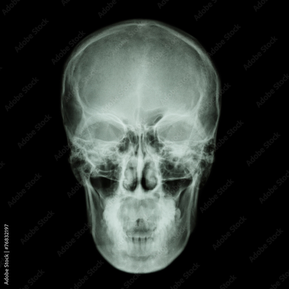 X-ray skull and Stroke ( cerebrovascular accident (CVA) ) X-ray skull and Stroke ( cerebrovascular accident (CVA) )