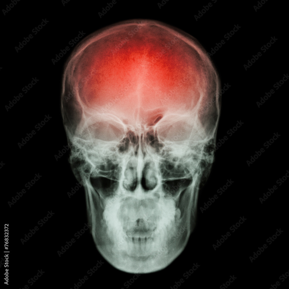 X-ray skull and Stroke ( cerebrovascular accident (CVA) ) X-ray skull and Stroke ( cerebrovascular accident (CVA) )