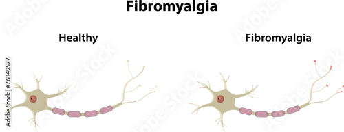 Fibromyalgia