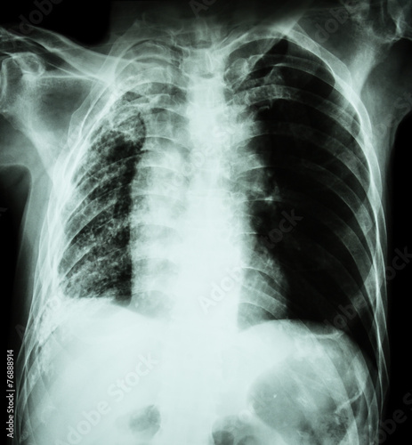 Pulmonary Tuberculosis and Right lung atelectasis