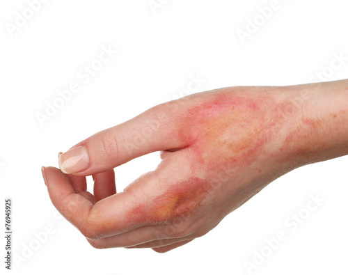 Horrible burns on female hand isolated on white photo