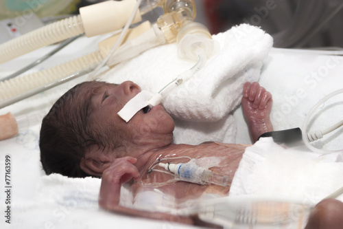 Cuadro en lienzo Portrait of newborn baby sleeping inside incubator