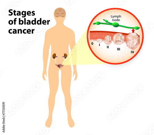 stages of bladder cancer