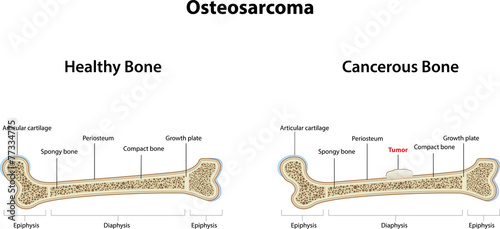 Osteosarcoma
