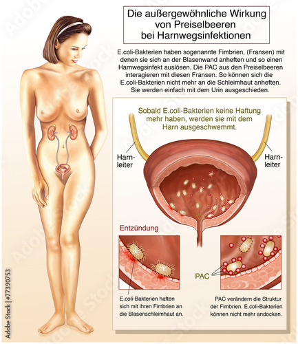 Tableau sur toile Preiselbeeren vertreiben Blaseninfekte.Blasenentzündung