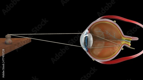 Hypermetropia normal eye