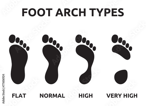 Foot arch types