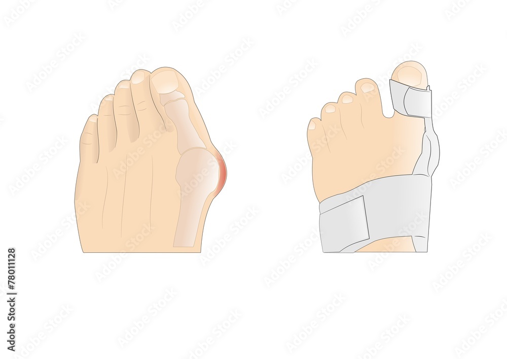 alluce valgo e correzione con tutore alluce valgo e correzione con tutore
