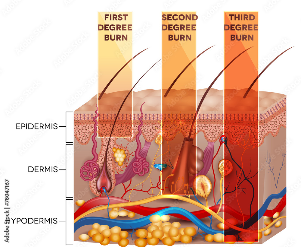 Skin burn classification. First, second and third degree skin bu - obrazy, fototapety, plakaty 