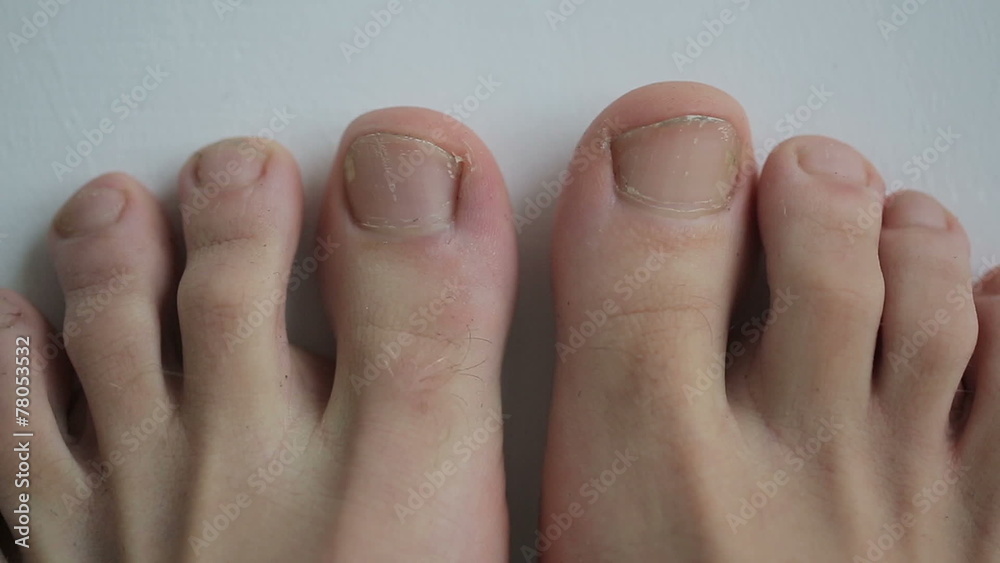 Young feet get old and sick with toenails fungal infection Young feet get old and sick with toenails fungal infection