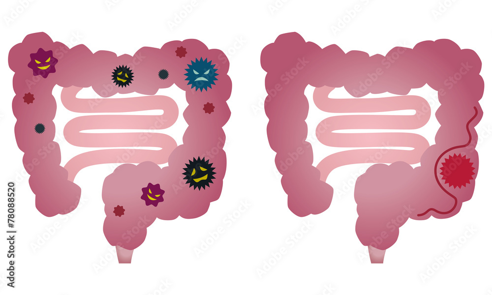 病気の大腸 大腸ガン Stock イラスト Adobe Stock