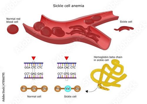 anemia falciforme, difetto genetico emoglobina