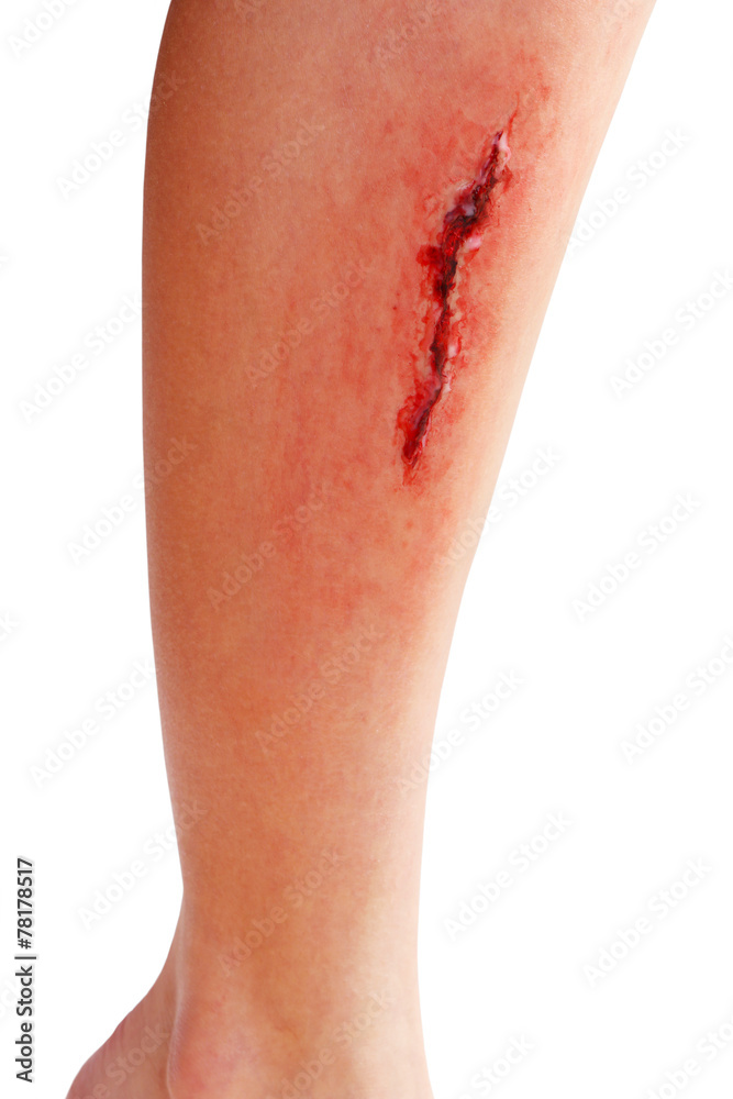 Foto de Injured leg with blood isolated on white do Stock | Adobe Stock