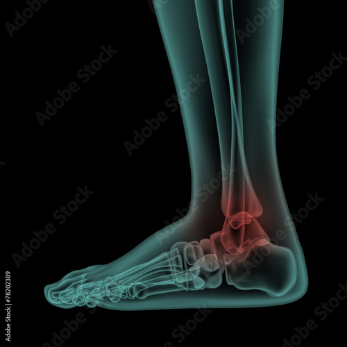 side x-ray view of human painful foot and ankle
