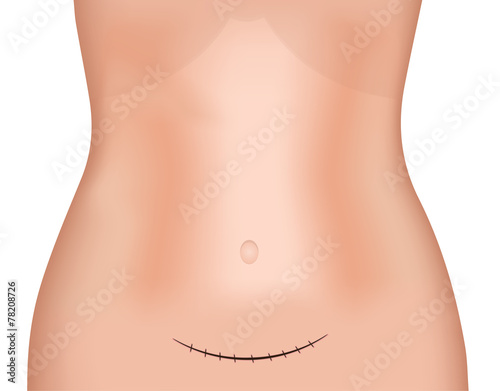 Supra Pubic Incision Scar