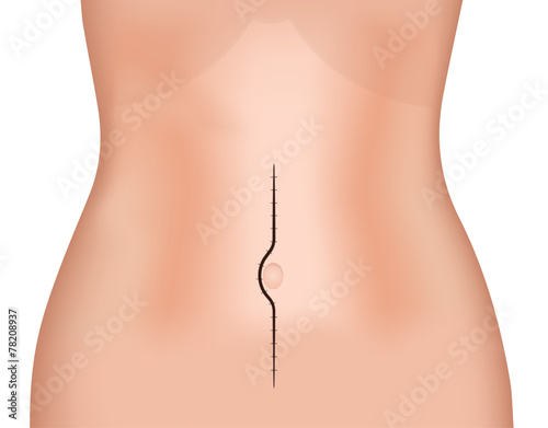 Midline Incision
