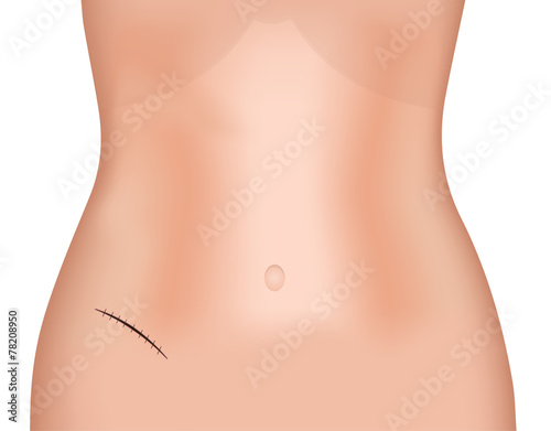 McBurney's Incision