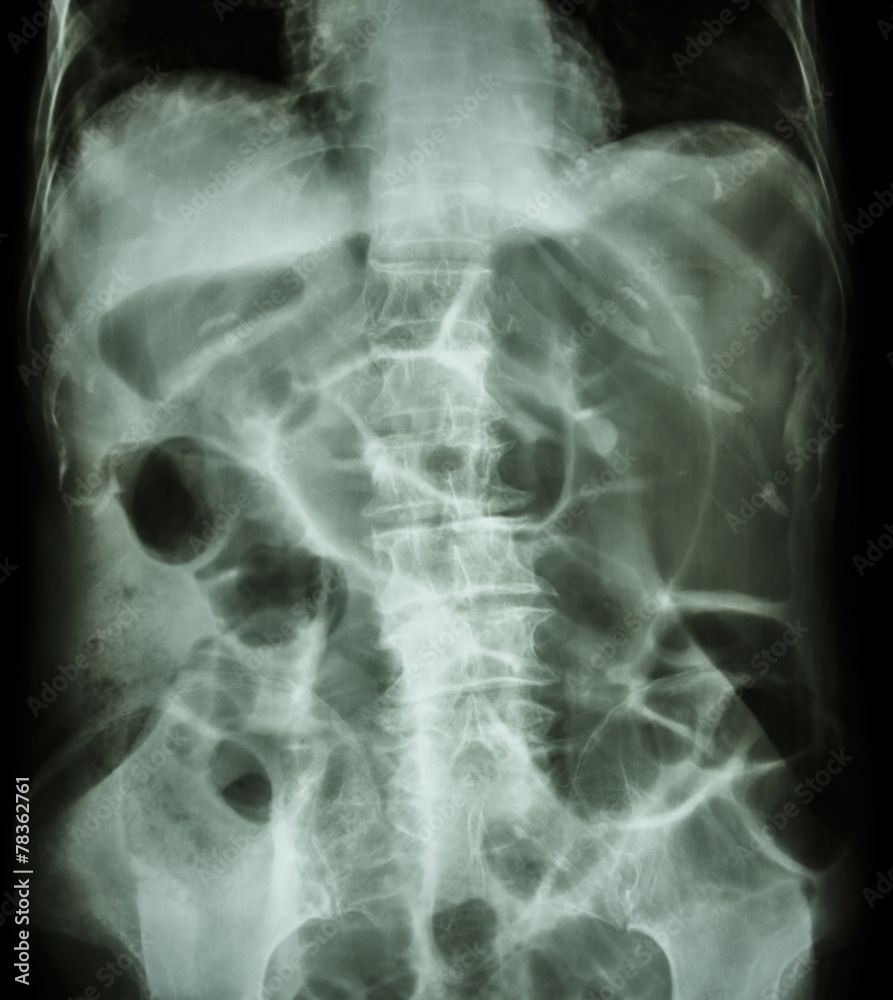 Bowel Obstruction ( X-ray abdomen supine position ) Bowel Obstruction ( X-ray abdomen supine position )