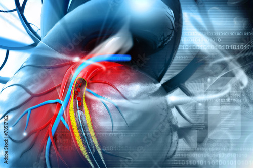 Stent angioplasty procedure with placing a balloon